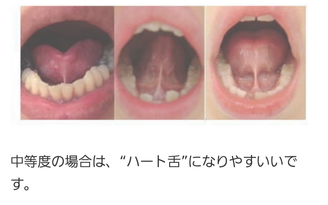 舌小帯短縮症(ハート舌)の手術。赤ちゃんのときと、5歳でやるときの違いの話。 STORYS.JP（ストーリーズ）