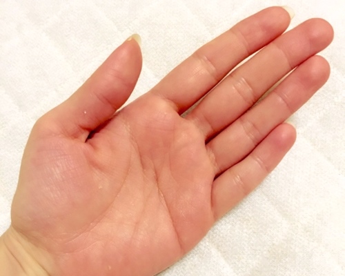 多汗症でひどい手汗を止めるには イオントフォレーシスの治療と体験談 Storys Jp ストーリーズ